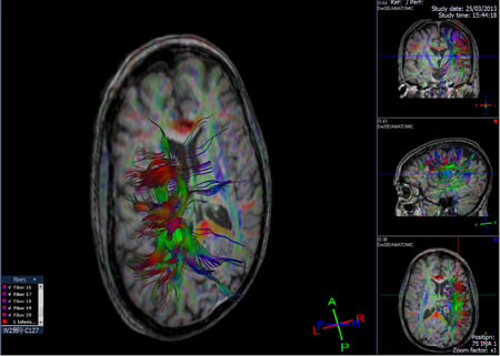 brain-dti